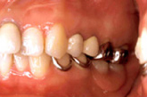 義歯（入れ歯）例