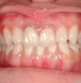 歯・歯茎のホワイトニング